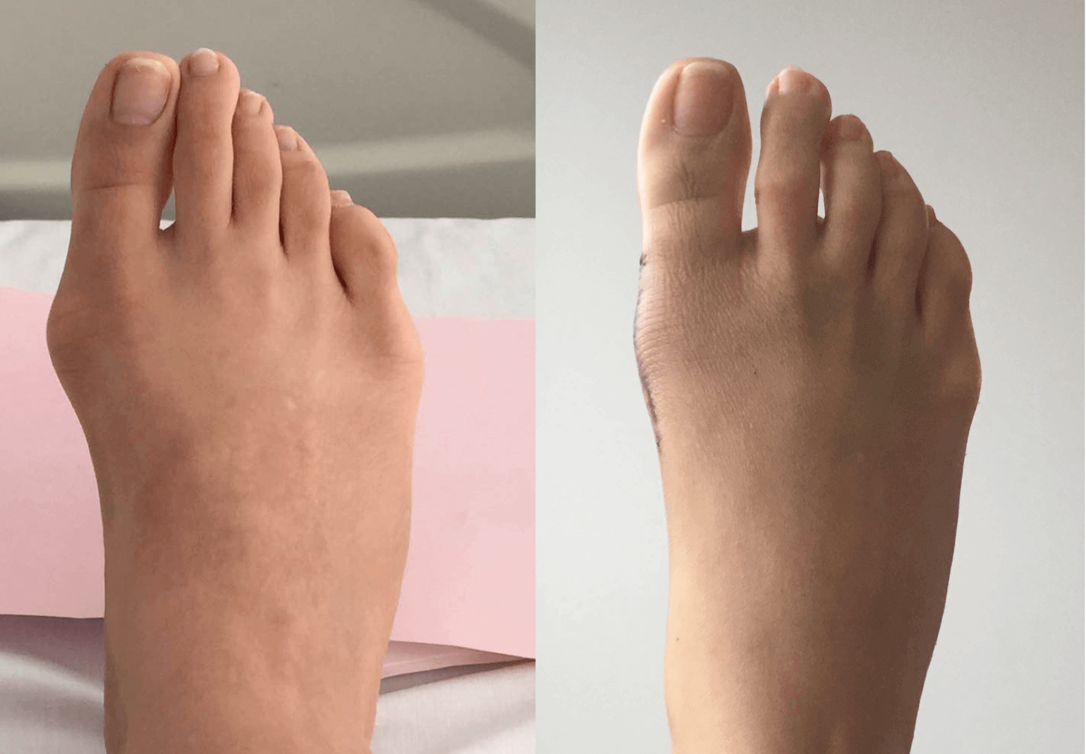 Rezultatul cu Footfix™ – corectarea monturilor